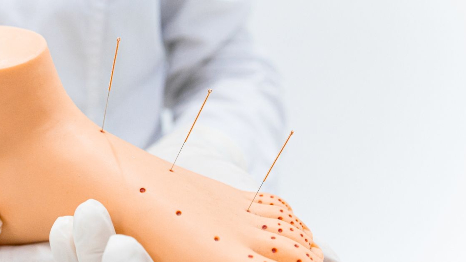 Agulhamento a Seco ou Dry Needling